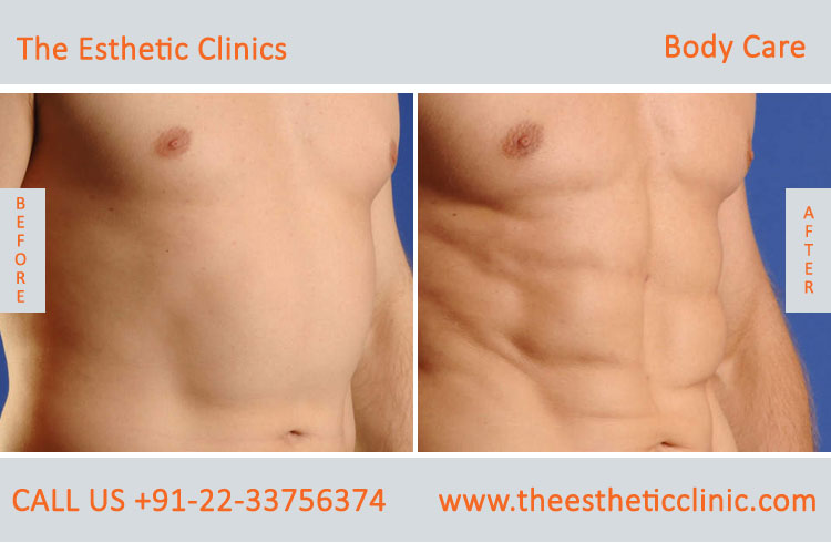 body care laser treatment before after photos in mumbai india (6)